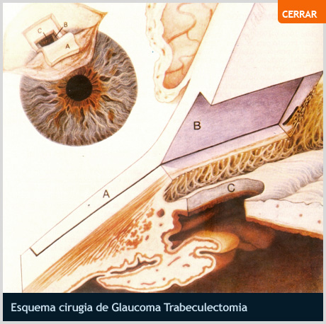 Esquema Cirugía de Glaucoma Trabeculectomía